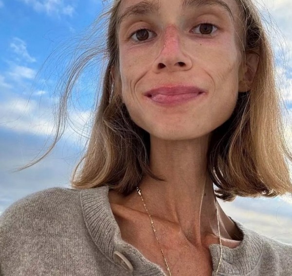 Умерла девушка, питавшаяся только фруктами — она весила чуть больше 20 кг